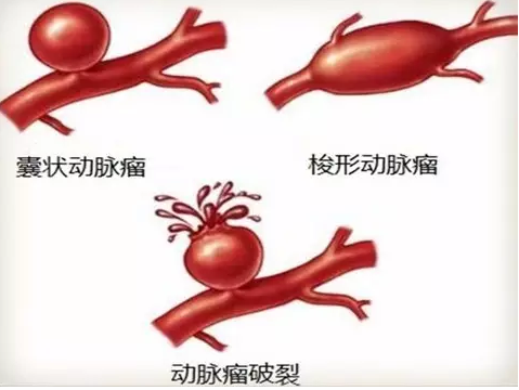 顱內待爆炸彈—動脈瘤