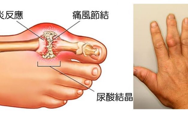 痛風急性發作：用藥莫入兩誤區