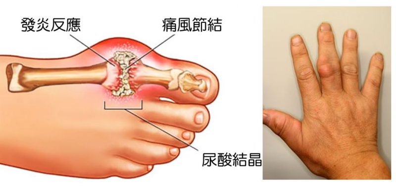 痛风急性发作：用药莫入两误区