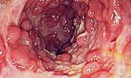 教你分辨大腸癌症狀