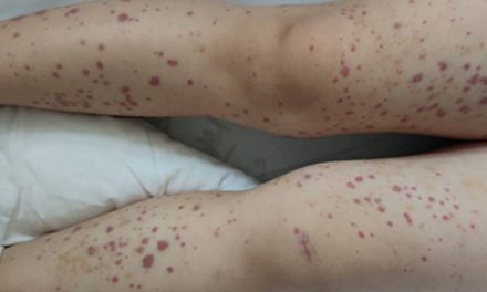 中医调养小儿过敏性紫癜