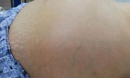 肝硬化八大并发症