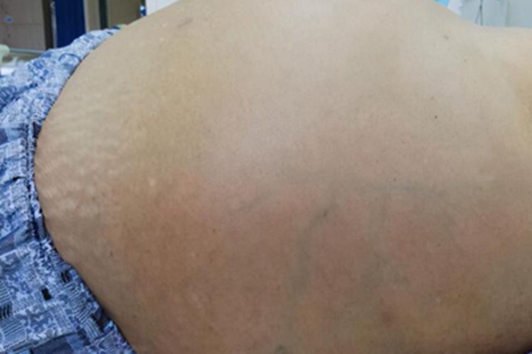 肝硬化八大并发症