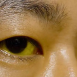 胰腺癌为什么难以发现？