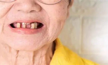 防治牙周病认识上需要纠错